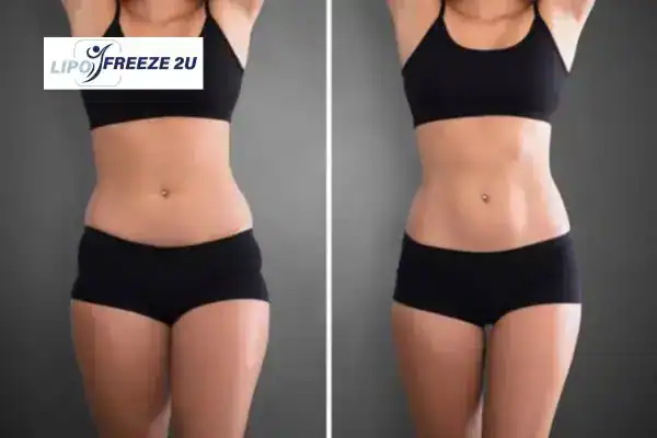 How Can LIPO FREEZE 2U Support Your Post-Pregnancy Body Recovery Ross-on-Wye?