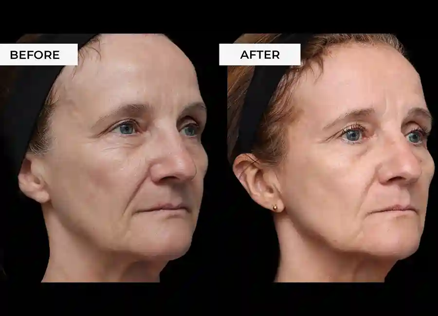 How Many RF Microneedling Sessions Will You Need to See a Difference Ross-on-Wye?