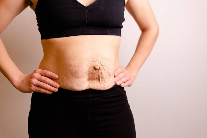 Is Surgery Really the Only Way to Repair Diastasis Recti Ross-on-Wye?