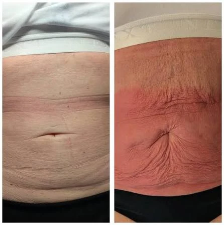 How Does RF Microneedling Improve Crepey, Thin and Uneven Skin Texture Ross-on-Wye?