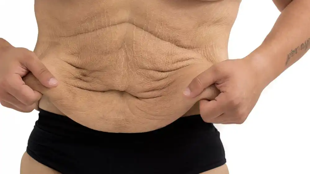 Why Does Weight Loss Medication Leave Some People With Loose or Sagging Skin Ross-on-Wye?